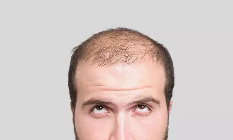 5 common causes of excessive hairloss in men