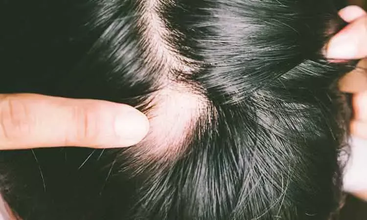 5 common types of hair loss | Dr Batra's™