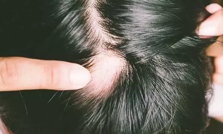 5 common types of hair loss | Dr Batra's™ 5 common types of hair loss | Dr Batra's™