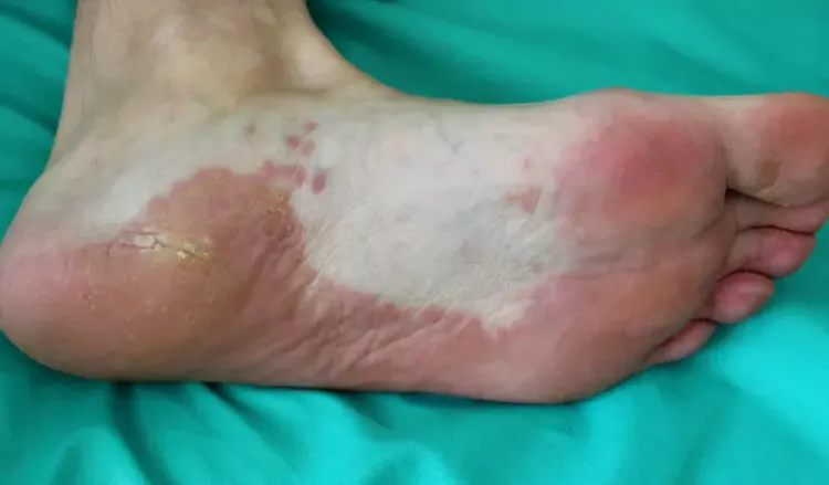 When to see a doctor for lichen planus?