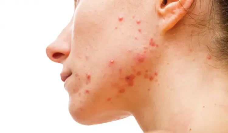 What causes monsoon acne and how to deal with it?