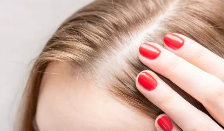 What causes baldness in women?