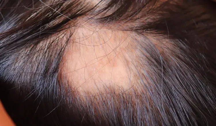 Homeopathy: The best patchy hair loss treatment