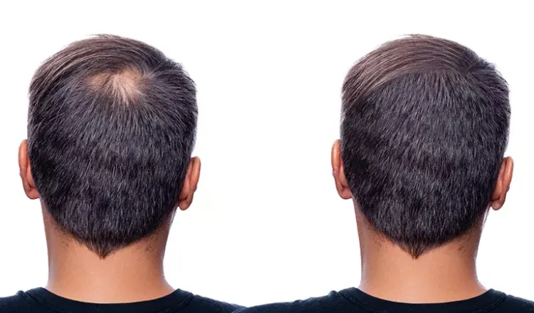 How Does Bio-Engineered Hair Treatment Help In New Hair Growth? - Dr.  Batra's®