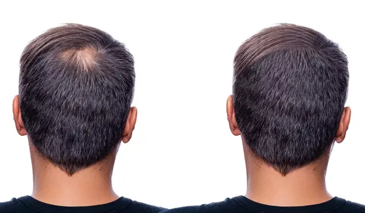 Hair Loss Treatments Men