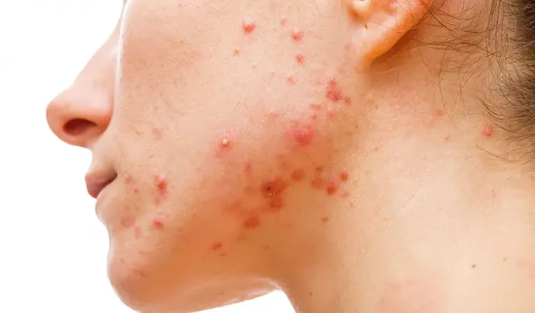 How to Treat Acne Before Scarring Occurs