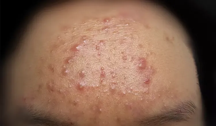How to treat monsoon acne?