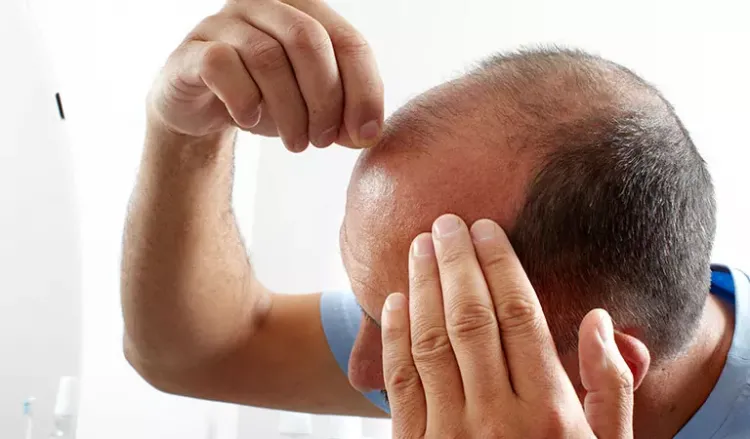 Is being bald making you depressed? Visit nearest homeopathic clinic