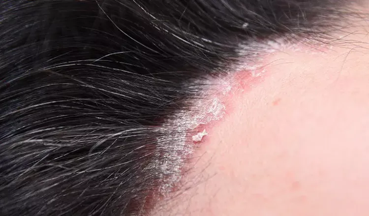 Is there a treatment for scalp psoriasis?