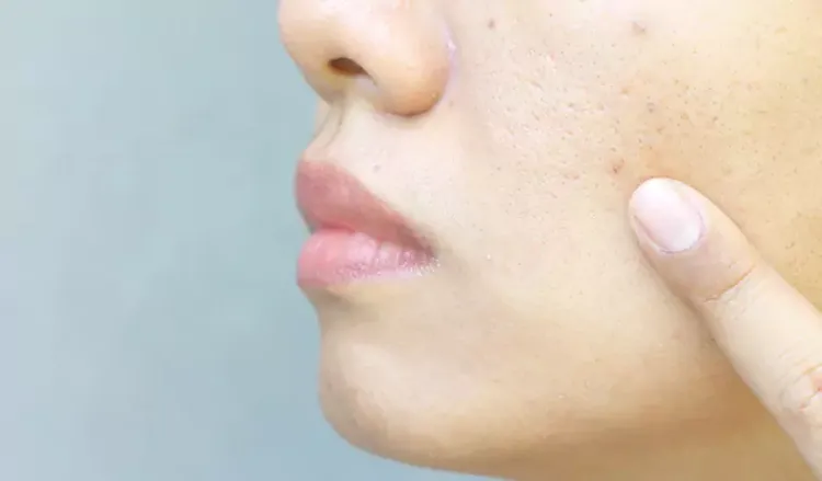 Large Pores vs. Acne Scars