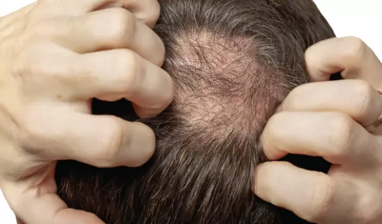 Why do men experience hair fall in the monsoon?