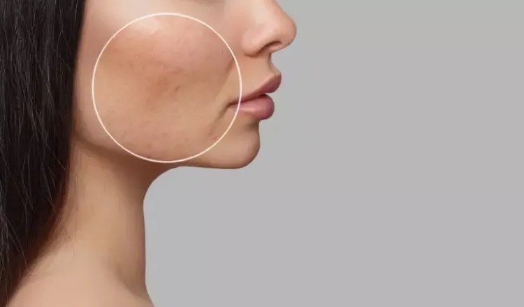 What are the characteristics of acne?