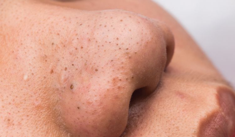 How to get rid of blackheads?