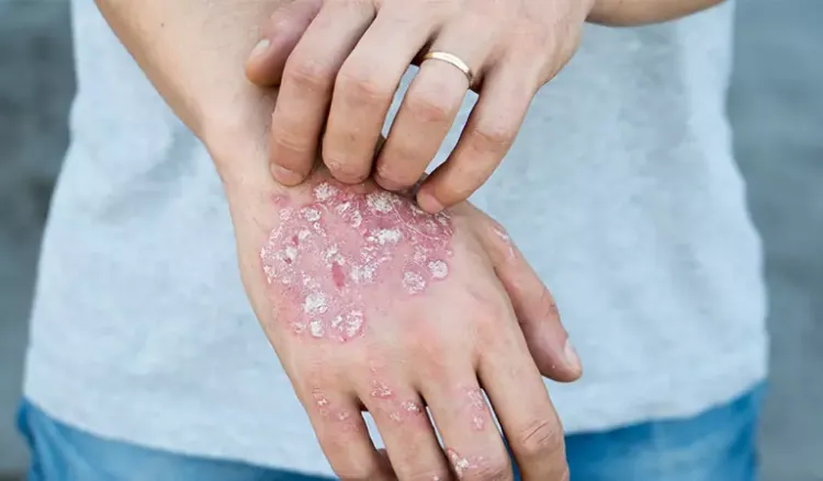 Psoriasis on hands: Causes & treatment