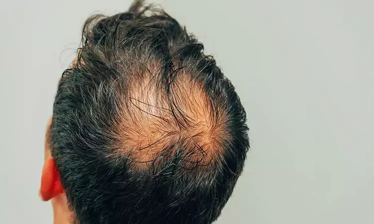 Fabel Ashley Furman sikkerhed SIGNS OF BALDING? HAIR LOSS SOLUTIONS AND HOMEOPATHY | Dr Batra's™