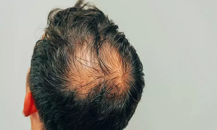 SIGNS OF BALDING? HAIR LOSS SOLUTIONS AND HOMEOPATHY | Dr Batra's™ SIGNS OF BALDING? HAIR LOSS SOLUTIONS AND HOMEOPATHY | Dr Batra's™