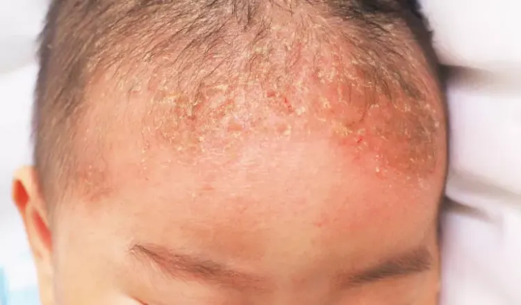 Will Seborrhoeic Dermatitis Go Away? - Dr. Batra's® Will Seborrhoeic Dermatitis Go Away? - Dr. Batra's®