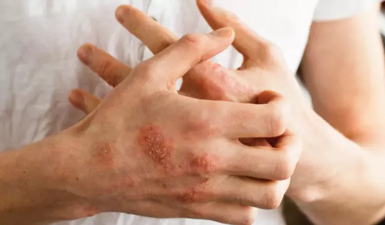 10 things to know about eczema