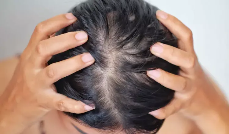 Solution for baldness in women