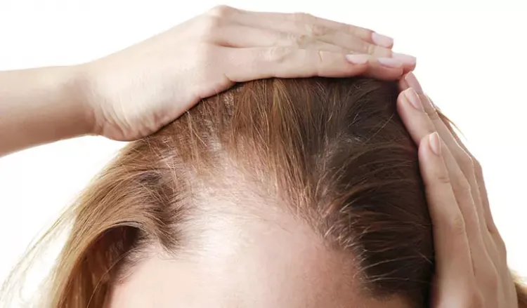 Unveiling myths about female pattern baldness