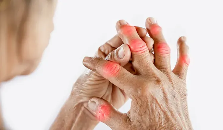 Use homeopathy to ease gout pains