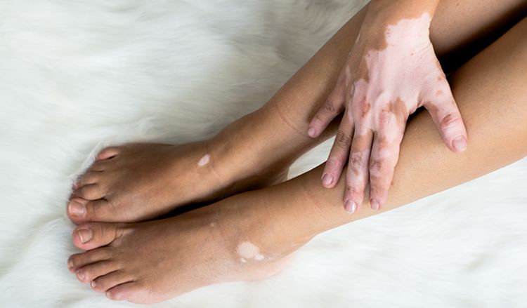 10 common questions about vitiligo