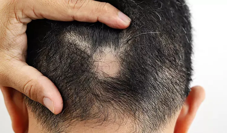 Sudden top hair fall