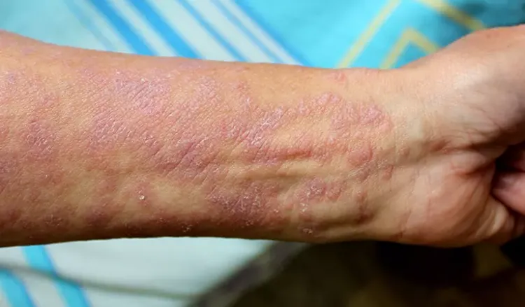 What is lichen planus classification?