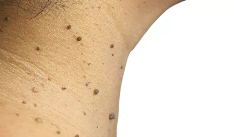 Why do you get skin tags?