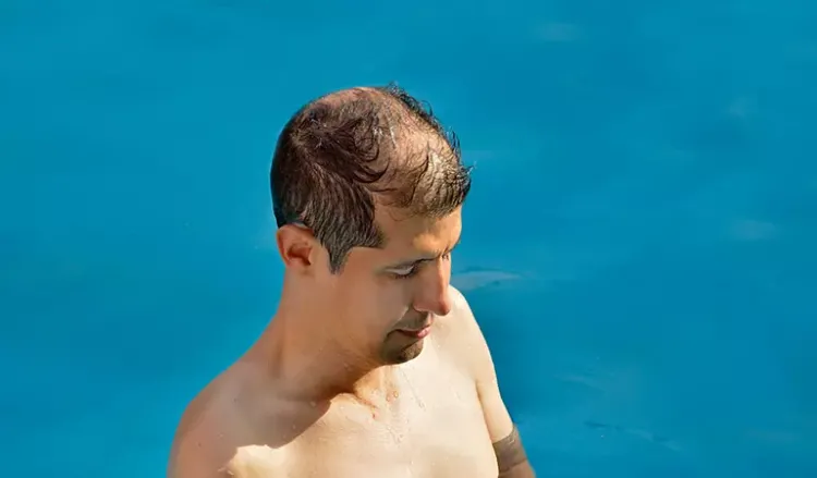 Why Men Experience Hair Loss In Summer? - Dr. Batra's® Why Men Experience Hair Loss In Summer? - Dr. Batra's®