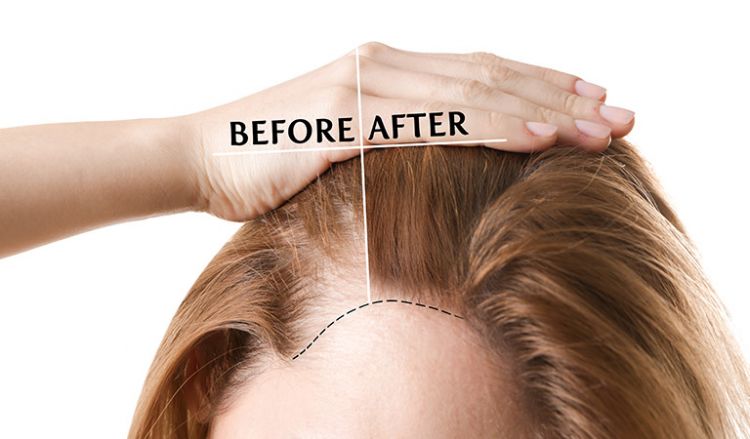 How to stop my PCOS hair fall and regrow fallen hair I have lost lots of  hair and my scalp is almost visible I am very much scared now Can someone  suggest