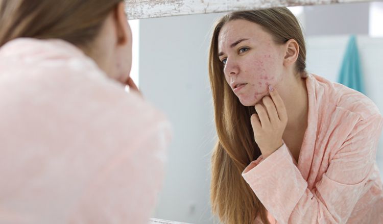 10 facts about acne