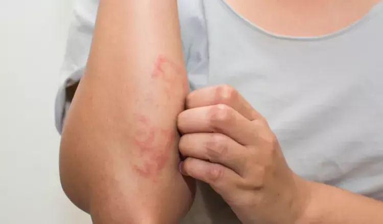 How to get rid of eczema?