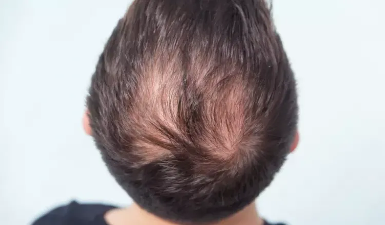 Hair Loss at the Nape of the Neck: What are the main causes? — Donovan Hair  Clinic