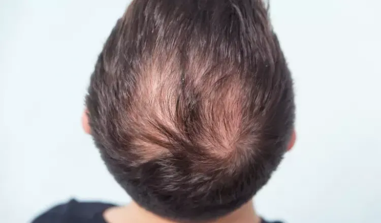 Tips for Hair Thinning Due to Male Pattern Baldness  AHS India