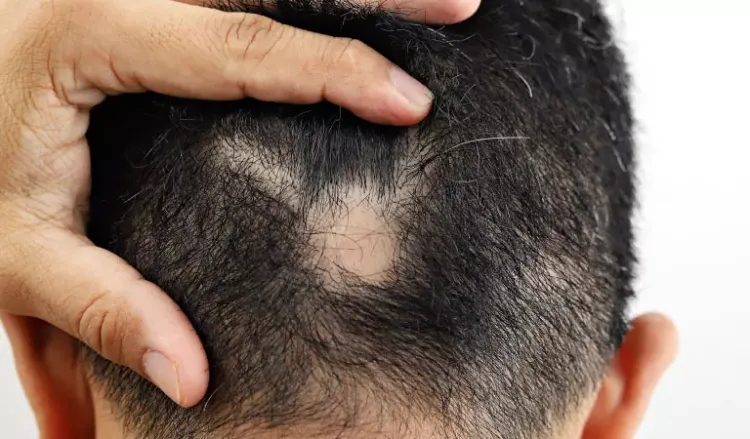 What causes bald spots?