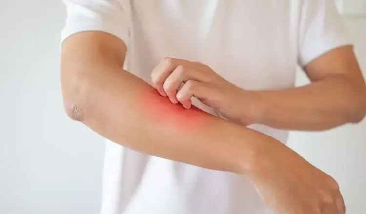 5 Things to Know About Psoriasis.