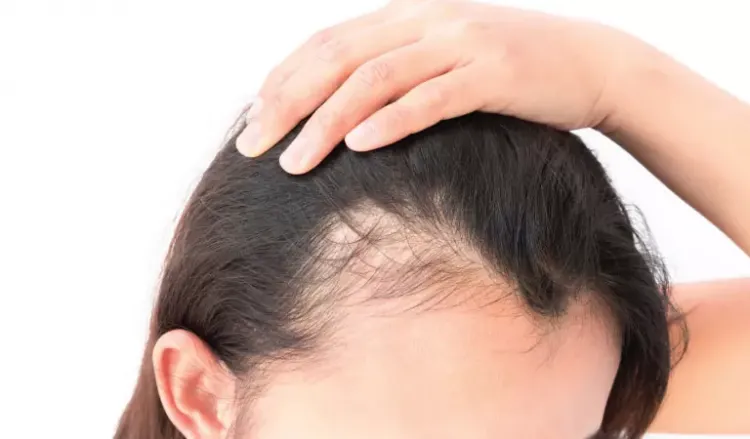 Thinning hair could indicate female pattern baldness