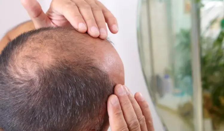 Reasons for hair loss in men