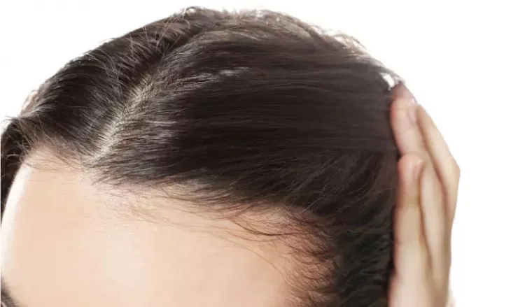 Treating Female Pattern Baldness with Homeopathy