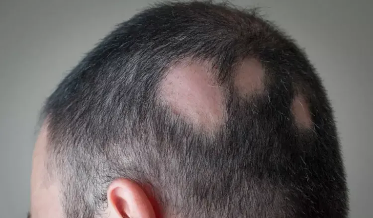 Types of Alopecia | Dr Batra's™ Types of Alopecia | Dr Batra's™