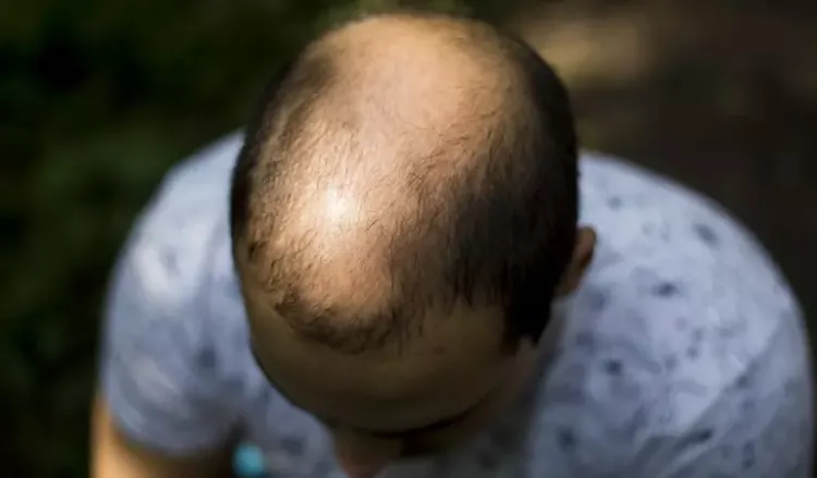 Male Pattern Baldness: Causes & Homeopathy Treatment