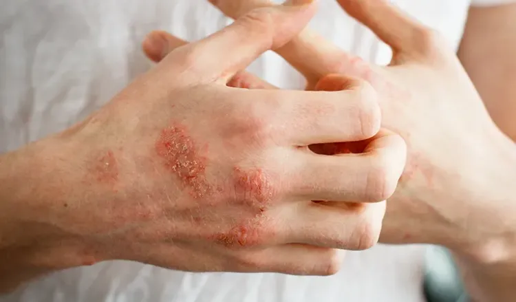 All you need to know about allergic eczema