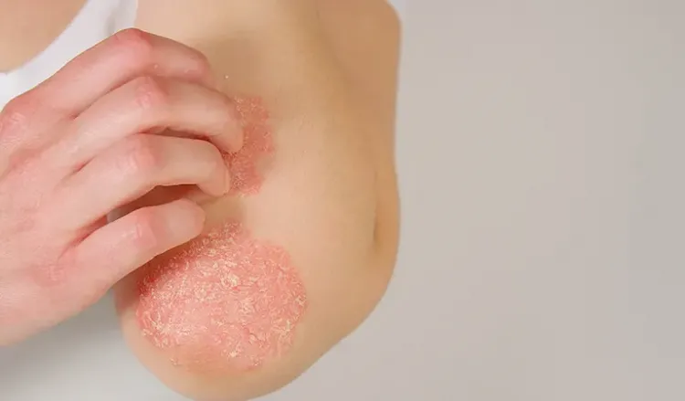 How to care for psoriasis symptoms when the season changes?