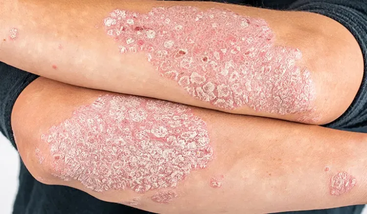 Is psoriasis hereditary?