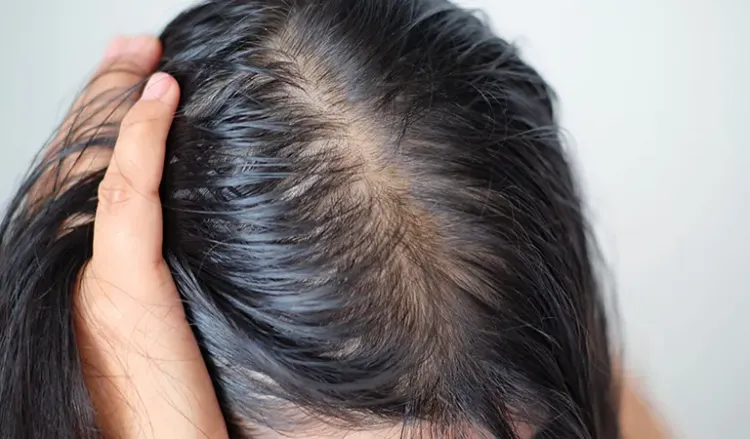 PCOS Hair Loss(Know The Tips To Manage Hair Loss Caused By PCOS)