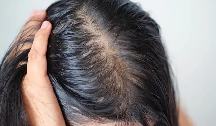 Best Homeopathic Medicine For Hair Loss  Hair Growth  100 Effective