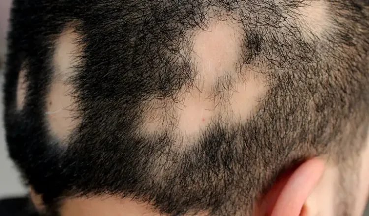 Why does alopecia areata occur?