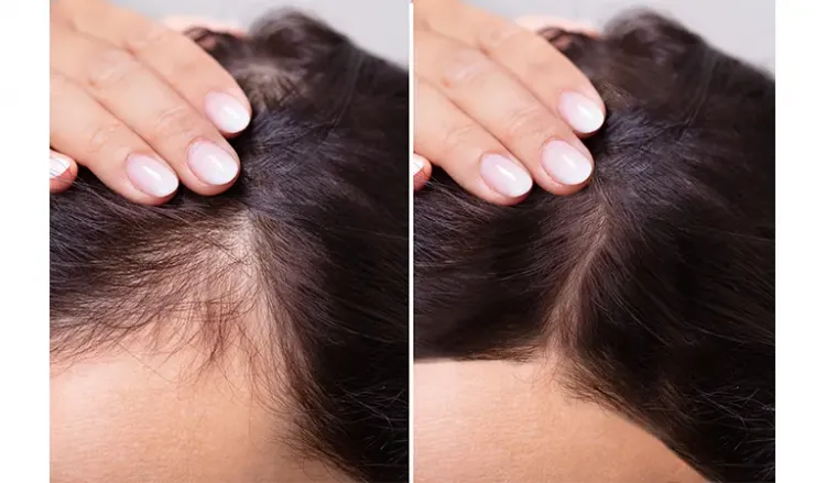 Hair vitalizing treatment vs GroHair Treatment - Dr. Batra's®
