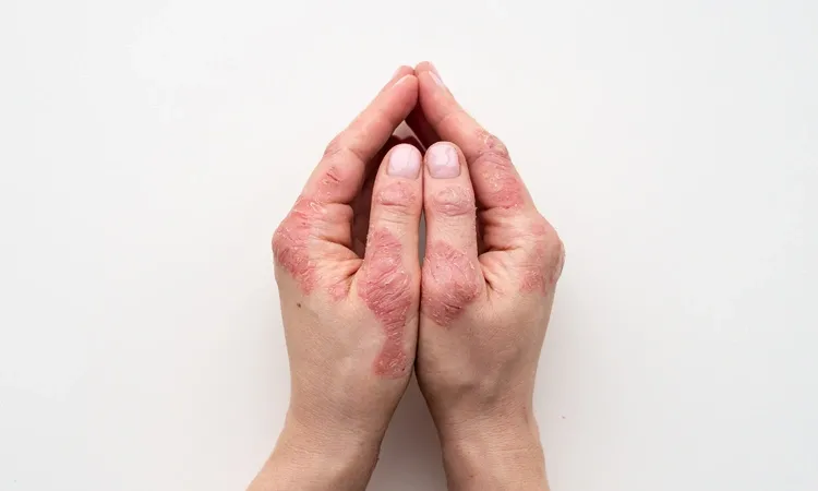  7 Psoriasis Triggers to Avoid